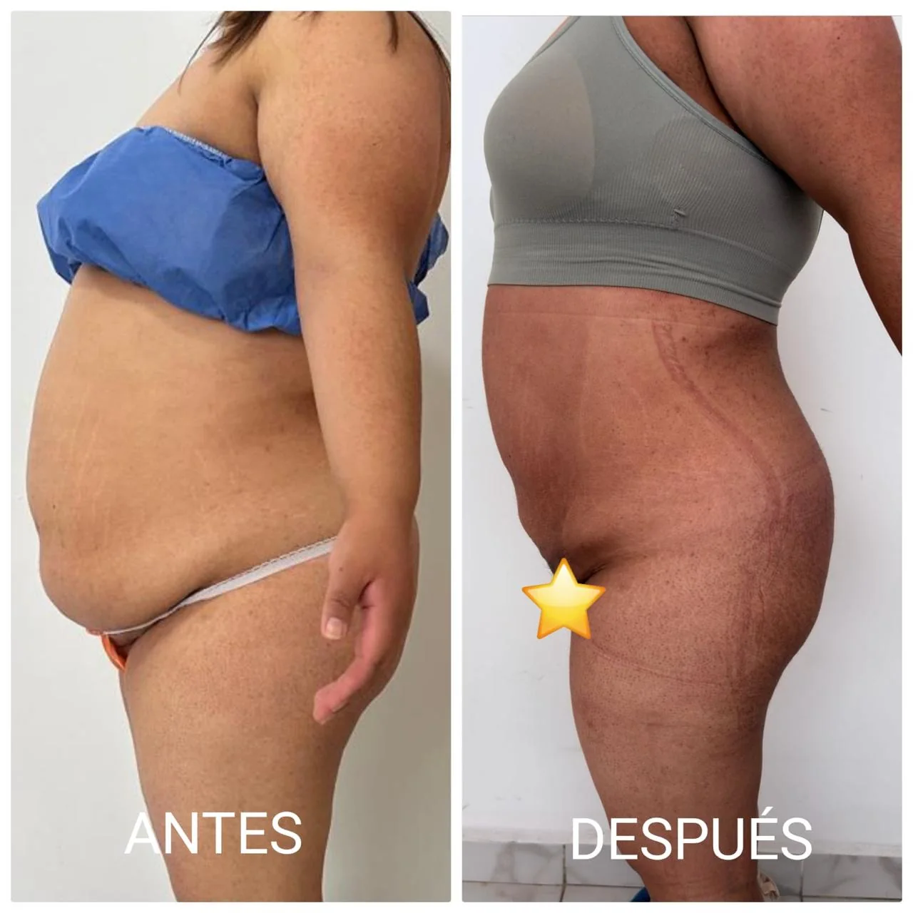 Resultado real de lipólisis láser: Contorno de abdomen y cintura, antes y después